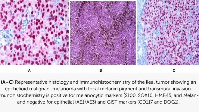 Ospedale di Alatri: pubblicato su “Frontiers in Oncology” un caso di melanoma primitivo dell’intestino tenue