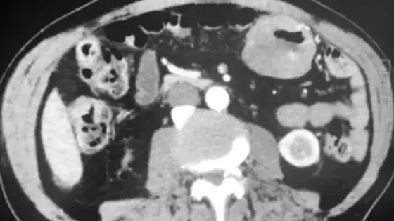 Raro caso di melanoma primitivo pubblicato su Frontiers in Oncology